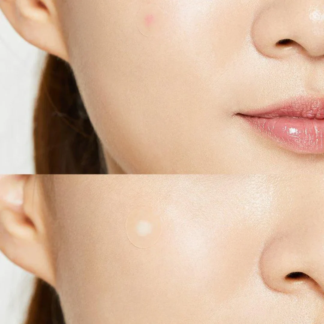 COSRX Acne Pimple Master Patch - Image 3